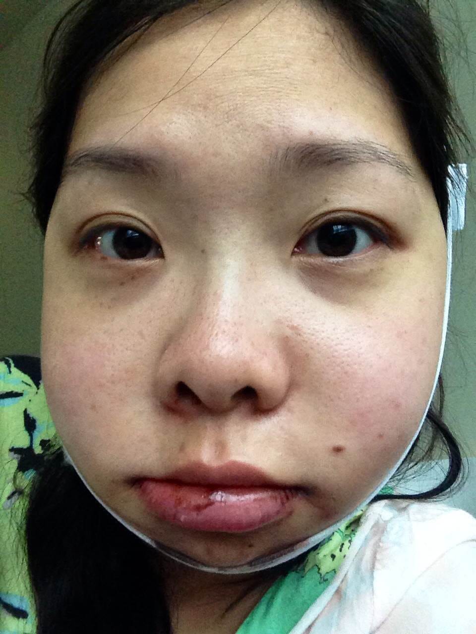 Third Week of Double Jaw Surgery Recovery by Rui Bai Medium