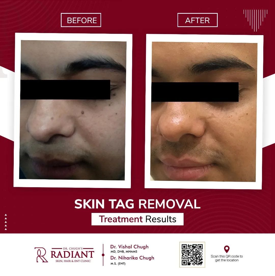 Best Laser Acne Scar Treatment in Jaipur Radiant Skin, Hair, Laser