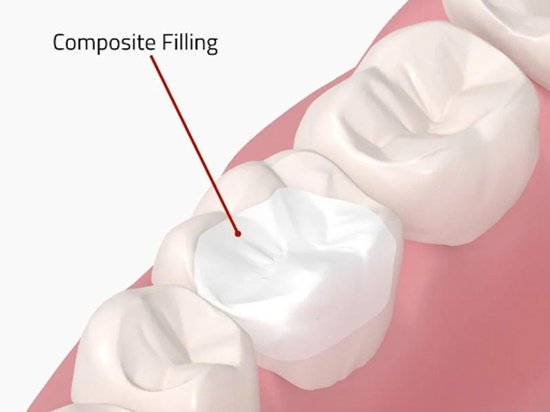 Difference Between Amalgam & Composite Fillings Landmark Dental Medium
