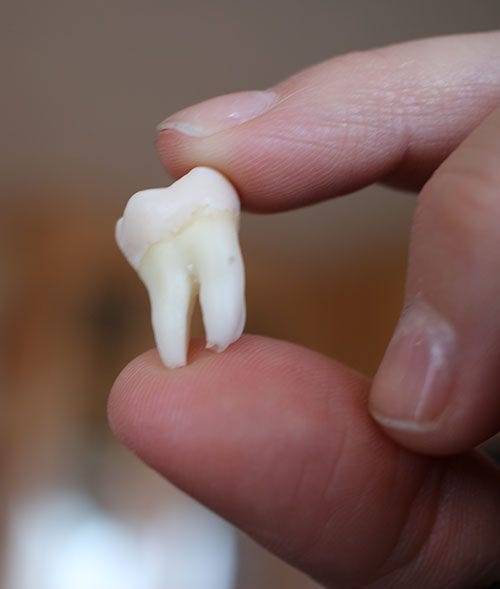 Can you replace wisdom teeth with dental implants? Versailles Dental