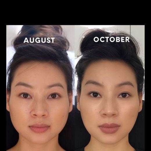Masseter Botox Before and After A Comprehensive Guide by Heerjawad