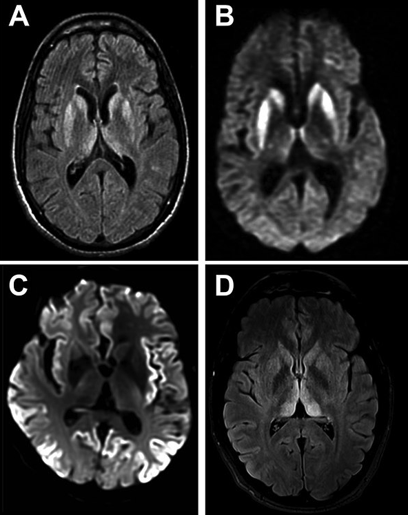 Creutzfeldt Jakob Disease (CJD). What is Creutzfeldt Jakob Disease