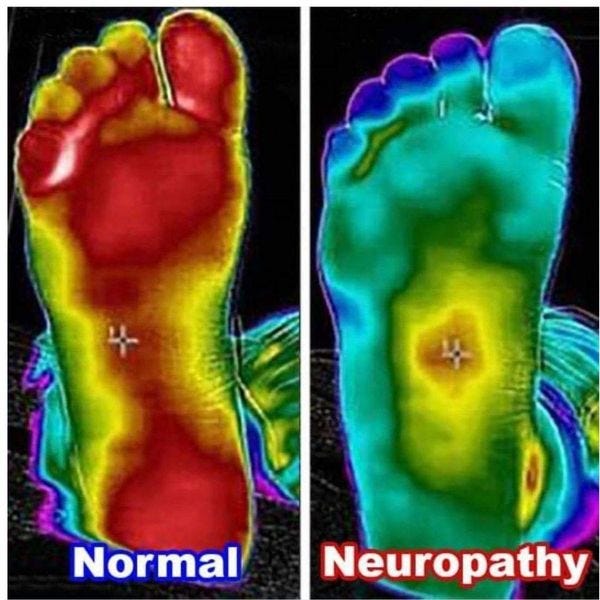 13 Ways to Get Rid of GriersonGopalan Syndrome, Burning Feet Syndrome