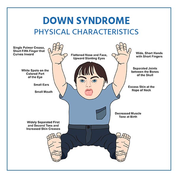down syndrome. Down syndrome, also known as trisomy… by Magdyos Tech