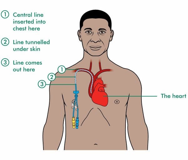 HICKMAN CATHETERS INSERTION. Hickman catheters (Hickman Lines)… by