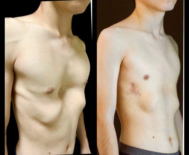 Pectus Excavatum (Sunken Chest). What is Pectus Excavatum? by Dr