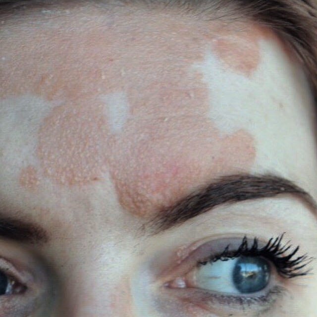 Top tips for facial psoriasis. Psoriasis can be tough to manage at the