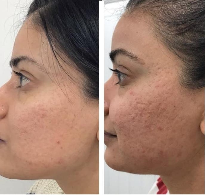 Why Is Your Face Breaking Out?. Acne breakouts are very common and