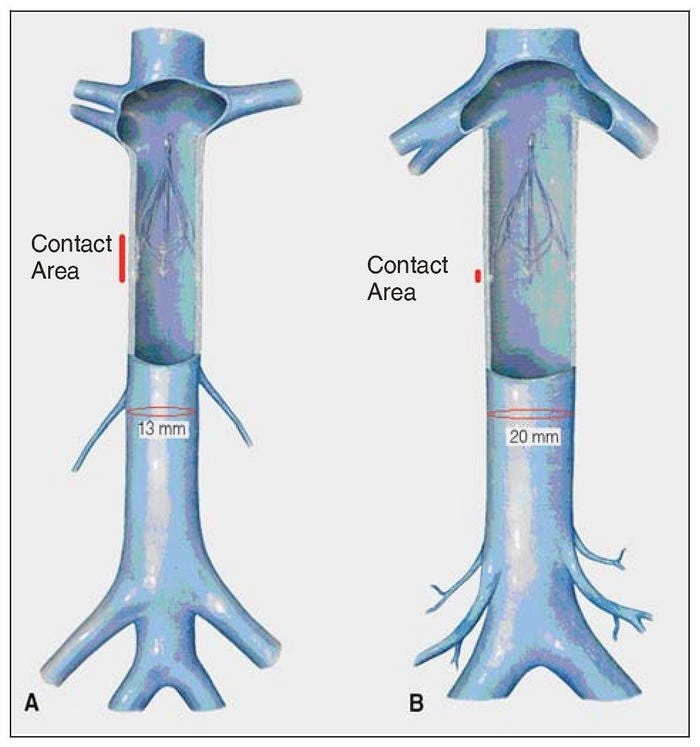 Side Effects of Blood Clot Filters by Thomas J Matthew Medium