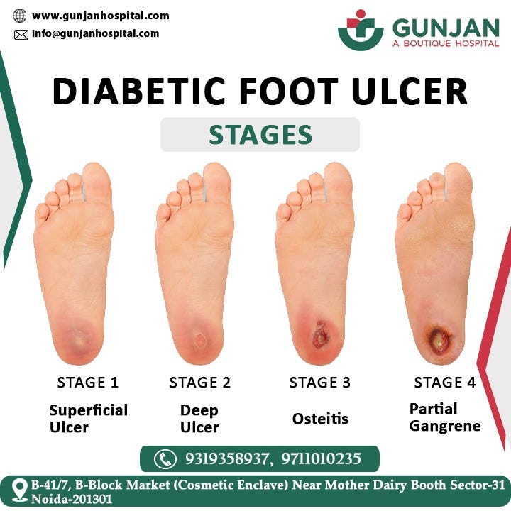 Comprehensive Diabetic Foot Ulcer Stages Treatment at Gunjan Hospital
