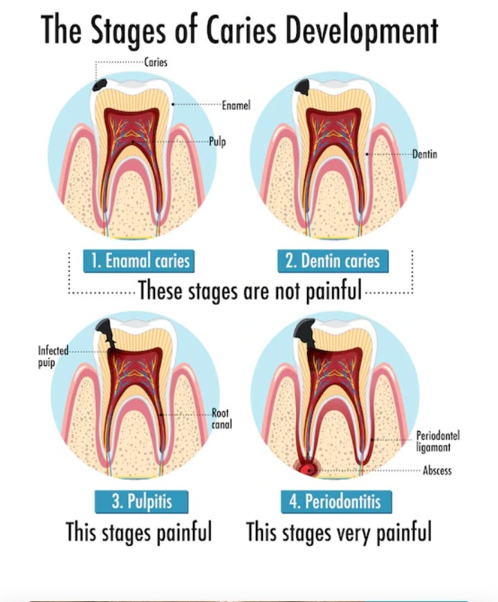 The Aetiology, prognosis, Diagnosis and Treatment of Dental Caries