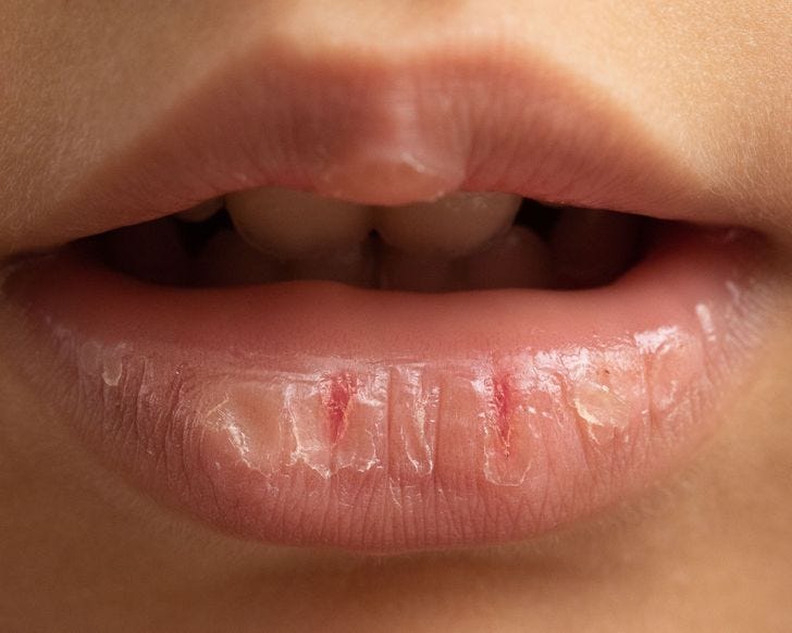 What Happens to Your Lips When You Use Lip Balm Too Often by Phoebe