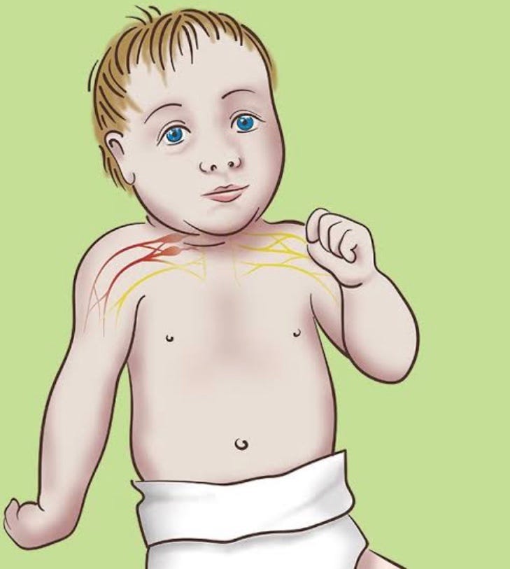 My baby’s arm doesn't move — Erb’s Palsy explained by Wendy Ekemezie