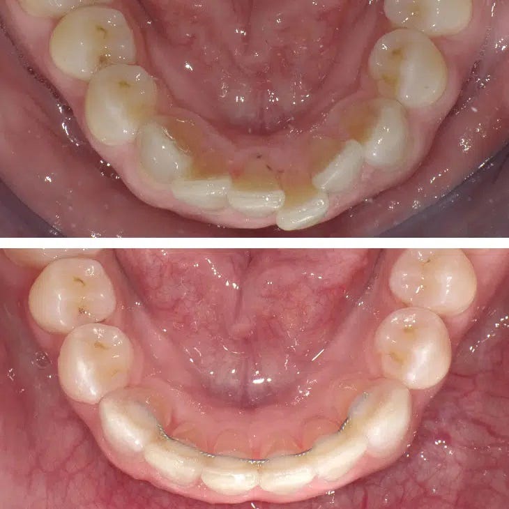 Permanent retainers. Congratulations! You made it through… by Gibbs