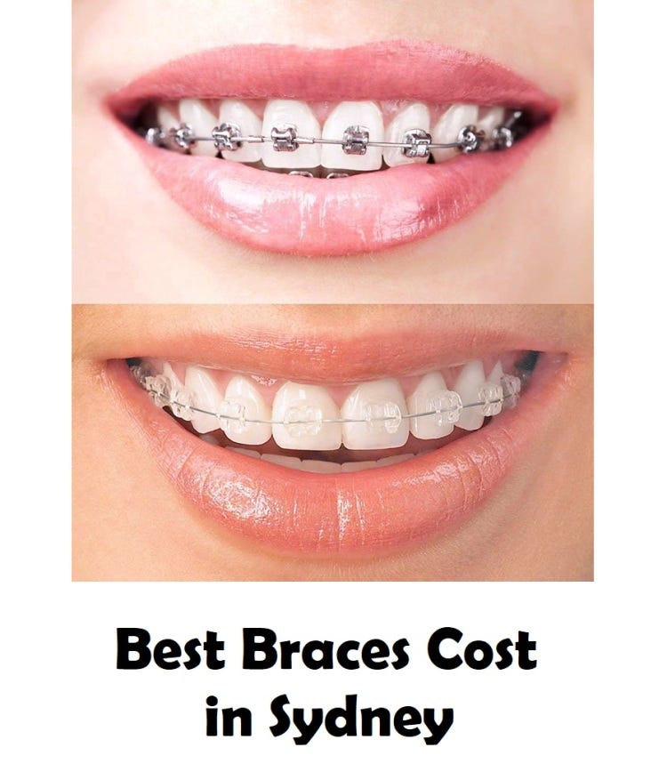Best Braces Cost in Sydney. How Much Do Braces cost? by