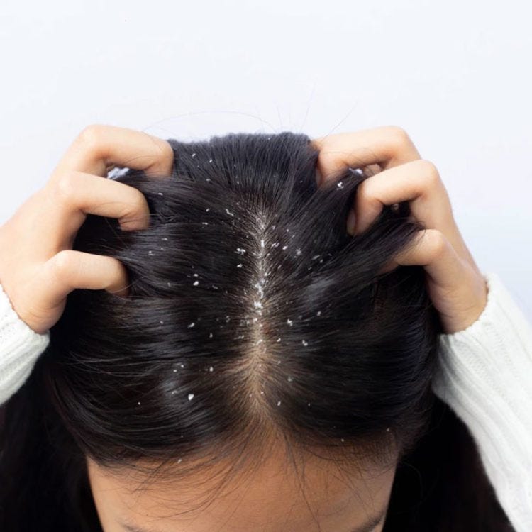 What is Anti Dandruff Treatment?. Dandruff is a common scalp condition