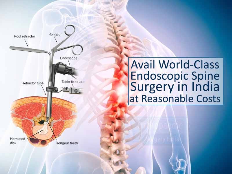 Endoscopic spine surgery cost suitable for your pocket by Spine