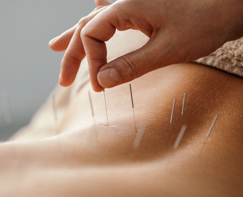 Exploring the Benefits of Acupuncture, Acupressure, and Yoga
