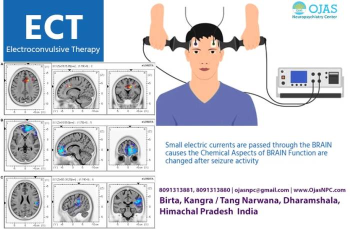 Electroconvulsive therapy used by many to battle depression Is ect covered by insurance