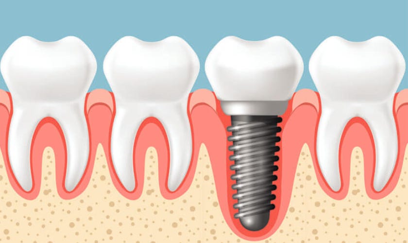 How to Mentally Prepare for Dental Implant Surgery by Lakeshore