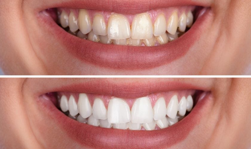 The Ultimate Guide to Teeth Whitening A Look at the Different Types