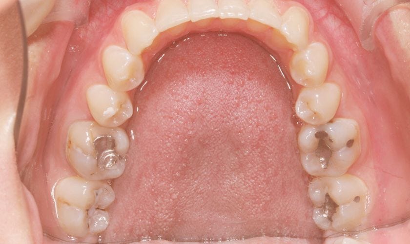 5 Reasons Why Tooth Filling Is The LessInvasive Option by PV Smiles