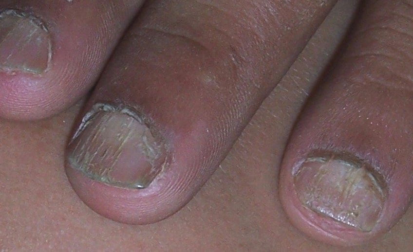 A Quick Guide to Nail Avulsion Treatment Skinology Clinic by
