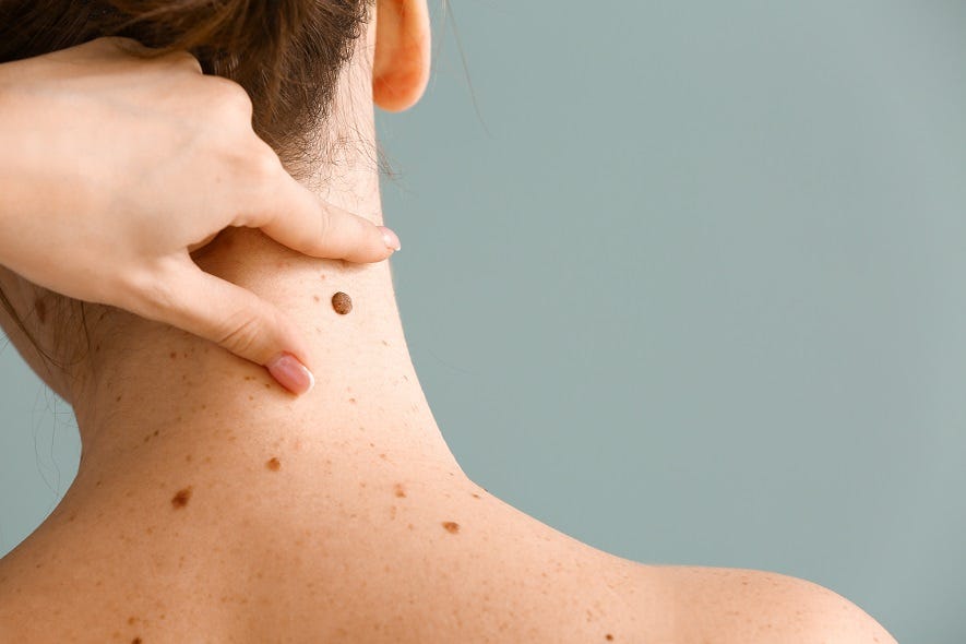 Identifying Skin Cancer Signs You Shouldn’t Ignore Florida Skin(04)