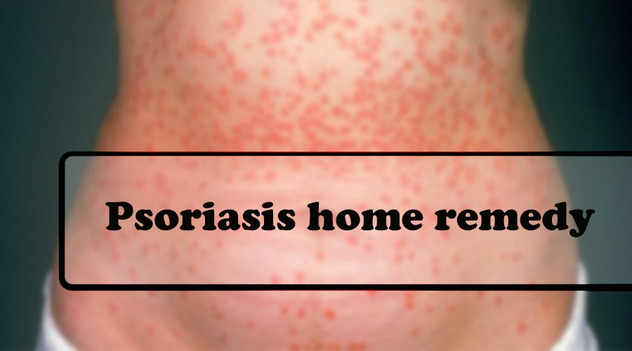 Psoriasis home remedy Marzep Parzeah Medium