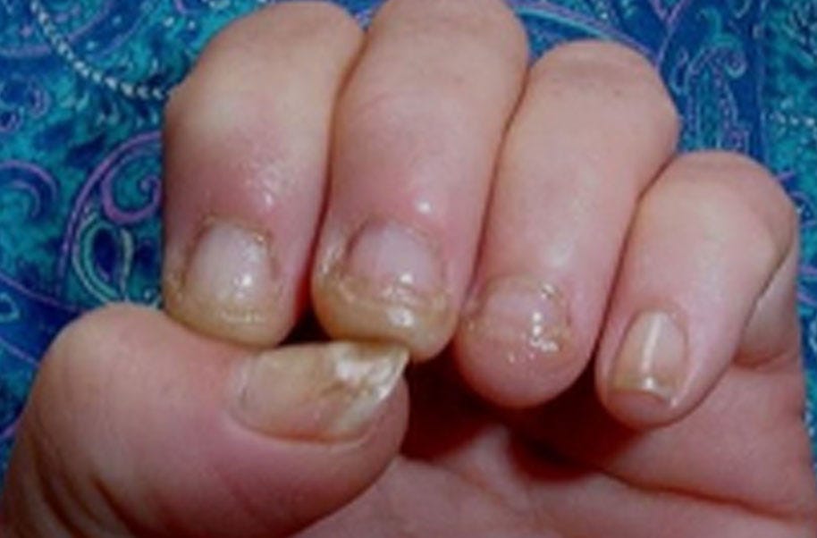 How to Catch Nail Fungus Early. Nail fungus, also known as… by Sol