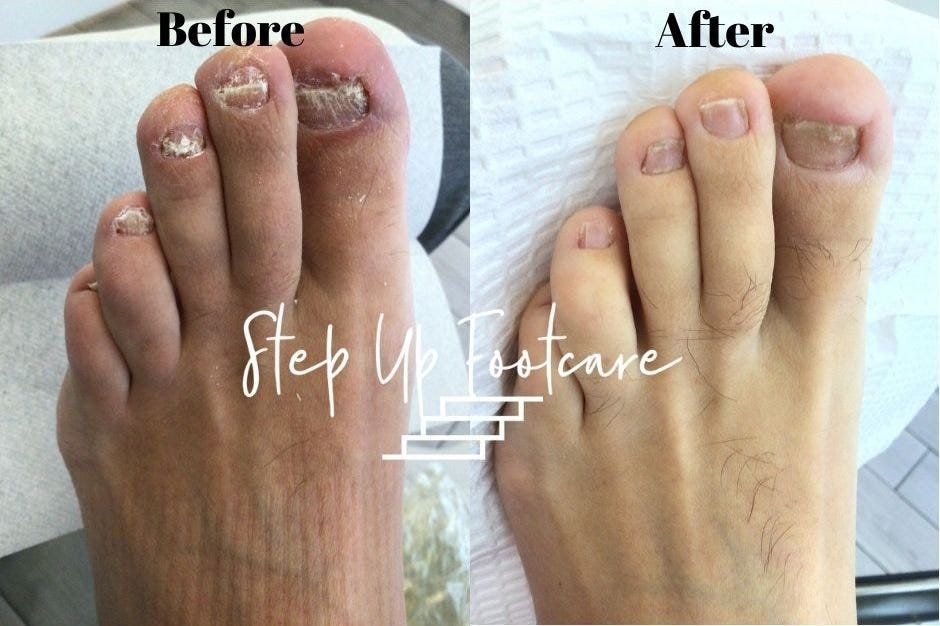 REAL cause of Toenail fungus revealed and How to Eliminate it in less than 14 Days by Estella