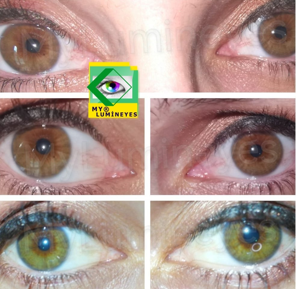 Laser Permanent Eye Color Change Without Surgery Procedure (Mylumineyes