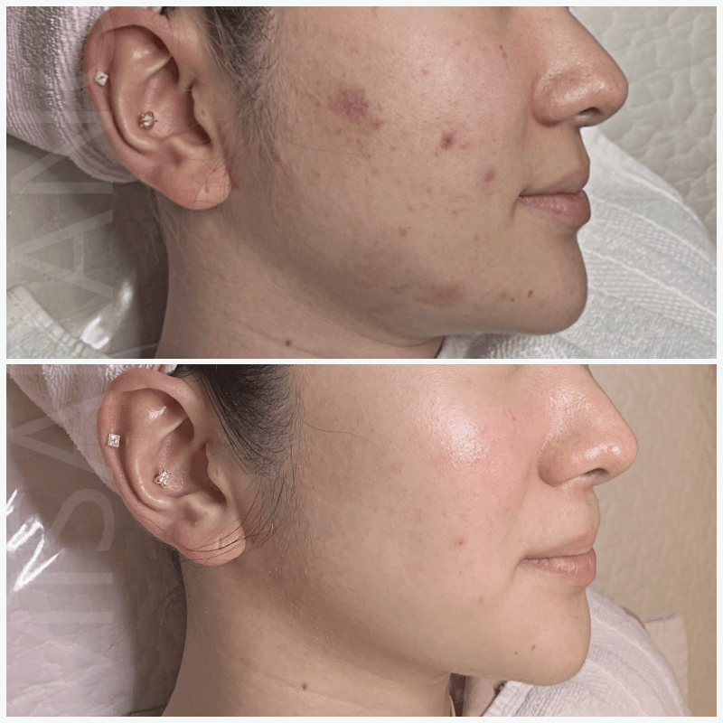 AGNES Acne Laser Treatment Skin Care Clinic Los Angeles