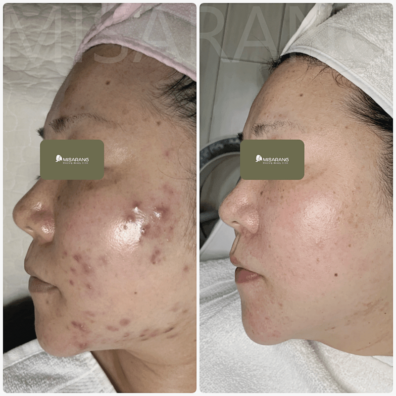 AGNES Acne Laser Treatment Skin Care Clinic Los Angeles