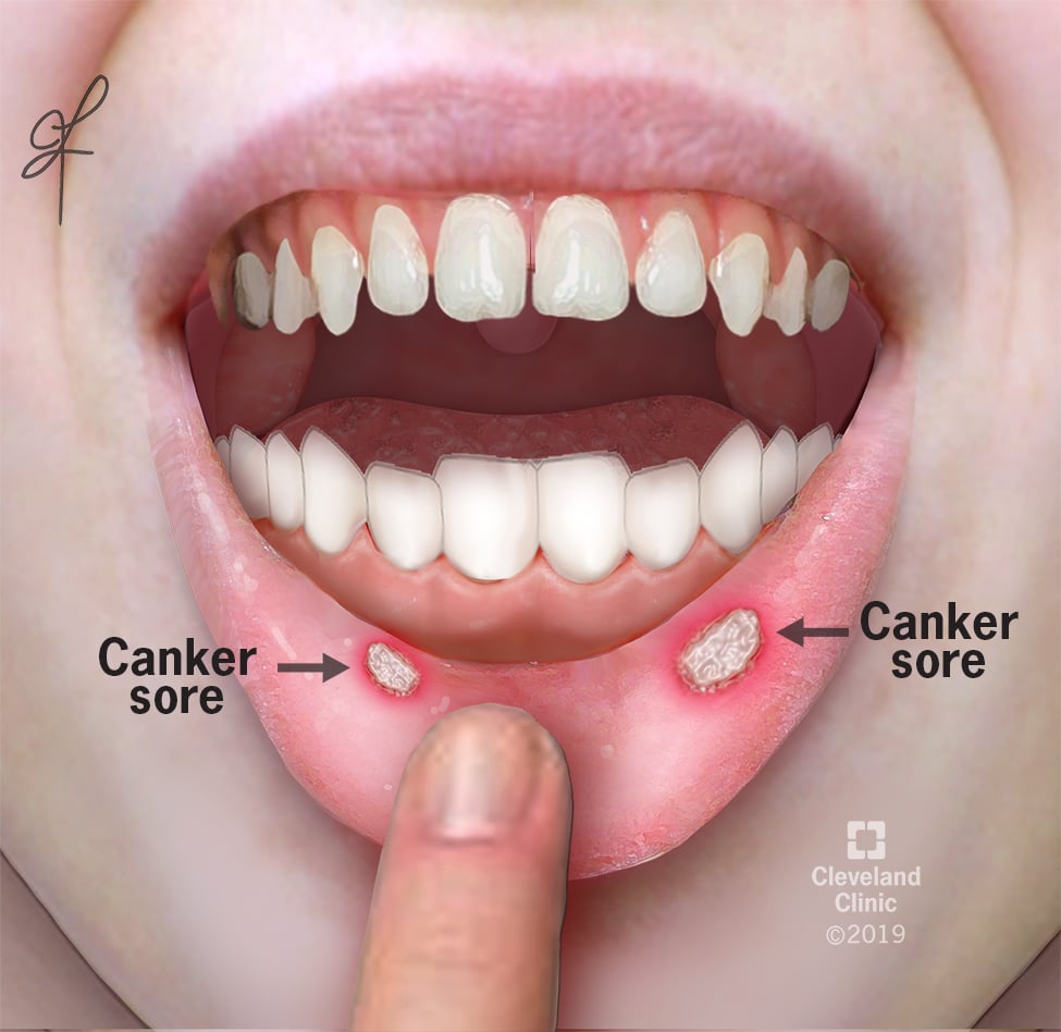 how i handle canker sores MIT Admissions