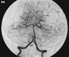 Mivir Cerebral Angiogram – Mivir