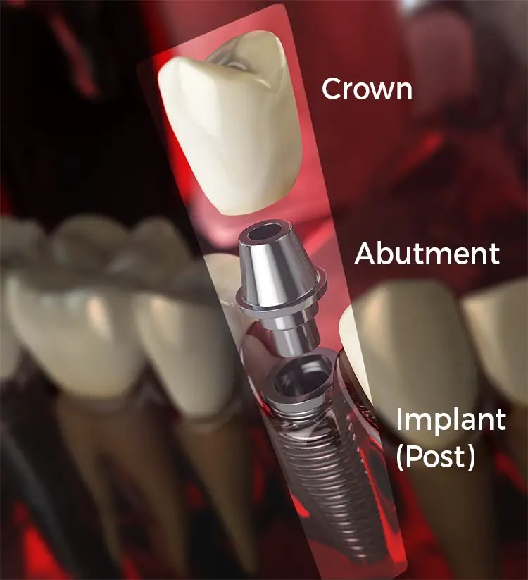 Dental Implant Dr. Cheng's Dental Tips
