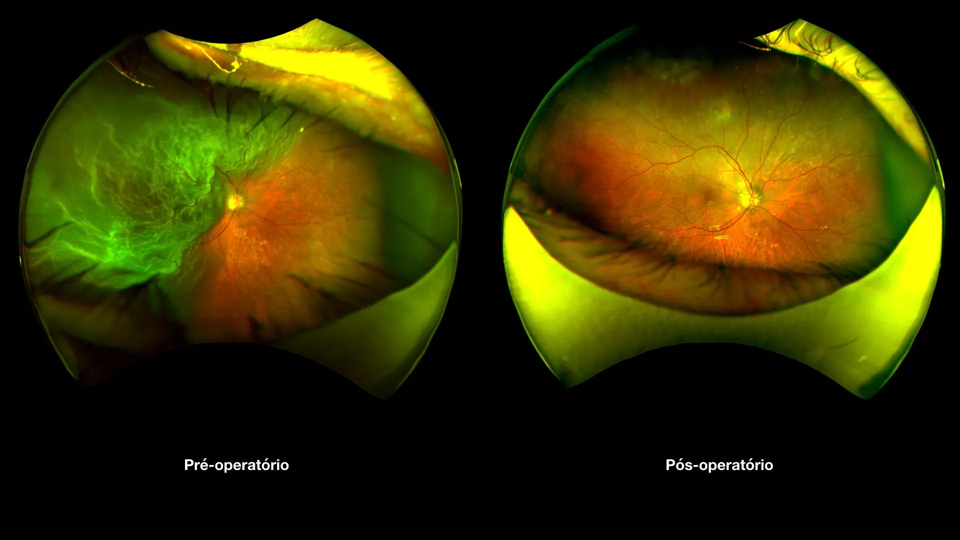DESCOLAMENTO DE RETINA Retina Clinic