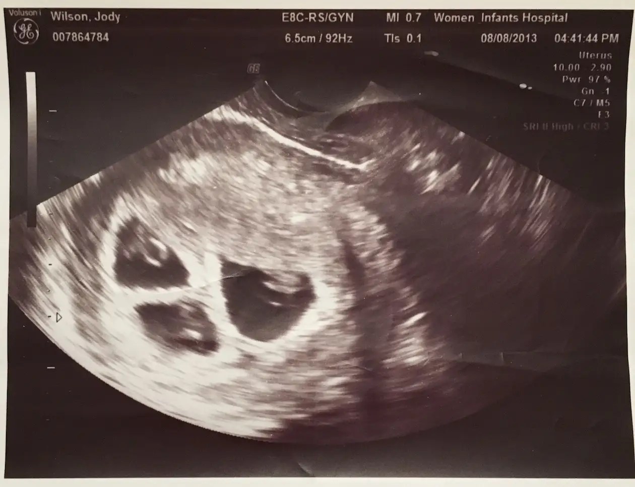8 Week Ultrasound Triplets