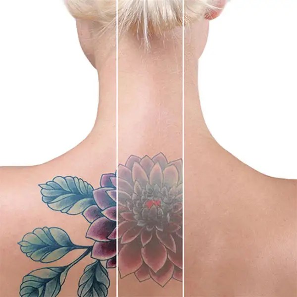 Jovem compartilha fotos de “remoção de tatuagem que deu errado” VEJA Remoção de tatuagem Carolina Miranda Dermatologia