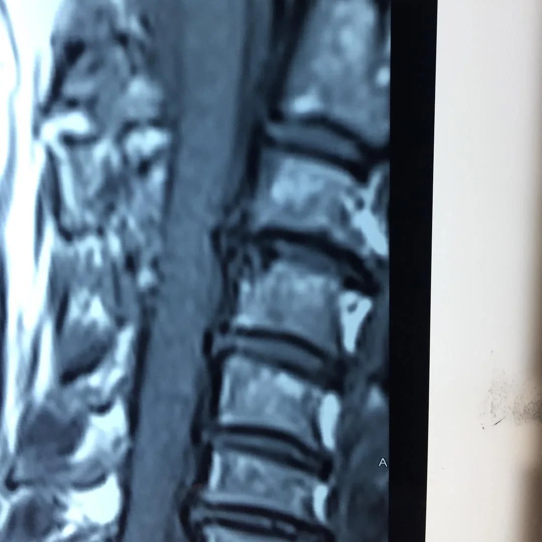 Cervical Vertigo Dr Kumaresh ENT Clinic