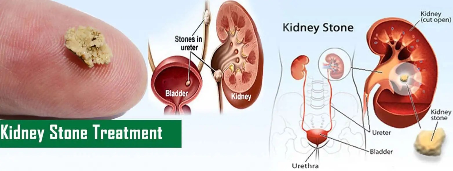 What are the causes and types of Kidney Stone Ajman
