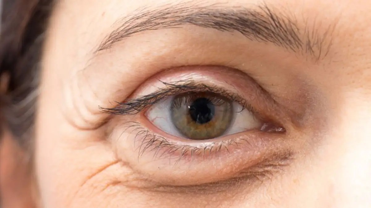 Why Is My Eye Swollen Underneath? Dark Circles Free