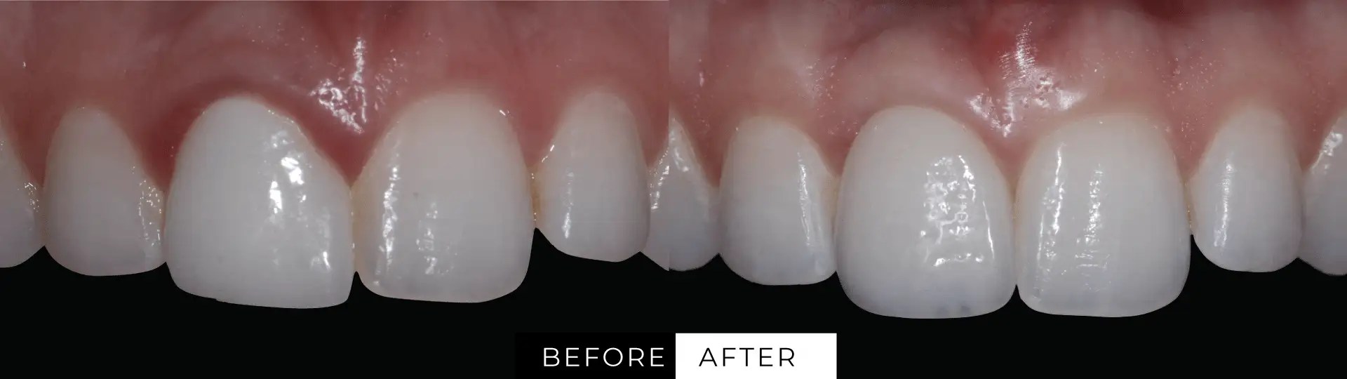 Dental Implants Las Vegas, NV JB White DDS