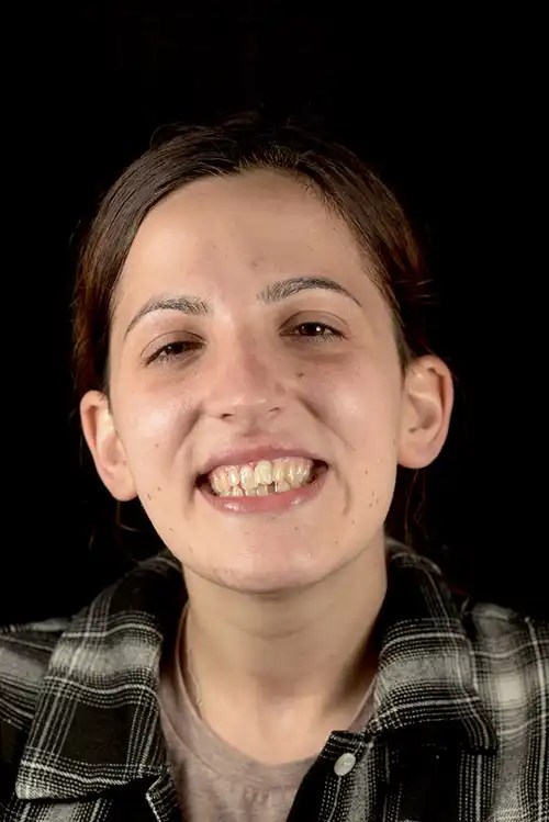 Composite Bonding Banning Dental Group