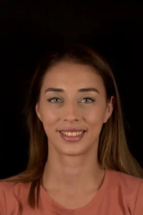 Composite Bonding Banning Dental Group