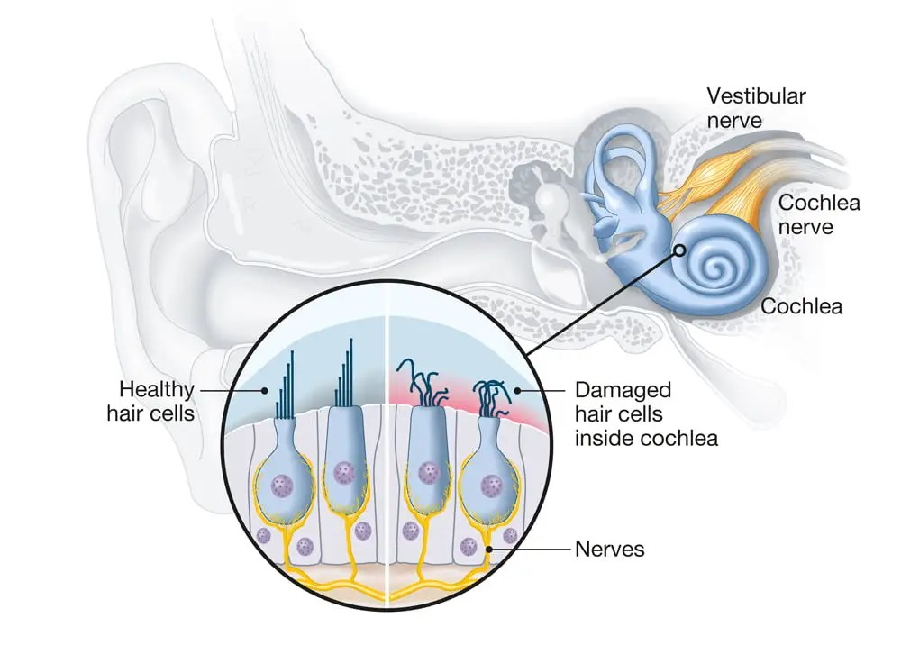 The Promising Potential of Hair Cell Regeneration Hearing Aid Accessory