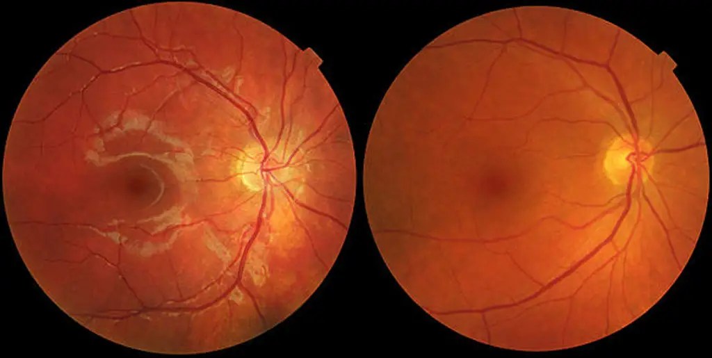 IS AGE RELATED MACULAR DEGENERATION TREATABLE? Axis Eye Clinic