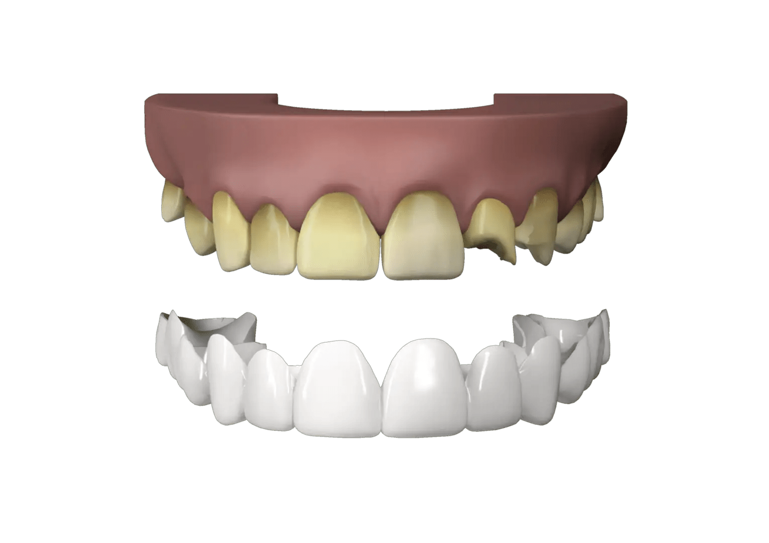 Clip In Veneers Payment Plans PressOn Veneers Brighter Image Lab