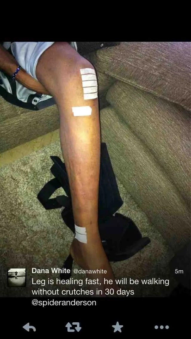 Pic of the Day Anderson Silva on the mend MMANUTS